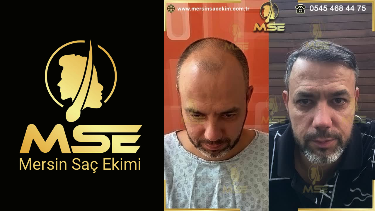 Mersin Saç Ekimi